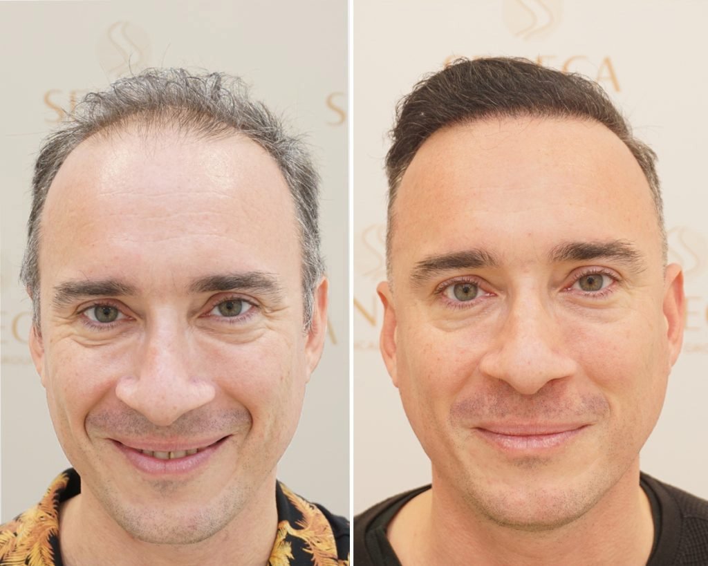 Hair Transplant Birmingham – Advanced Surgery That Works