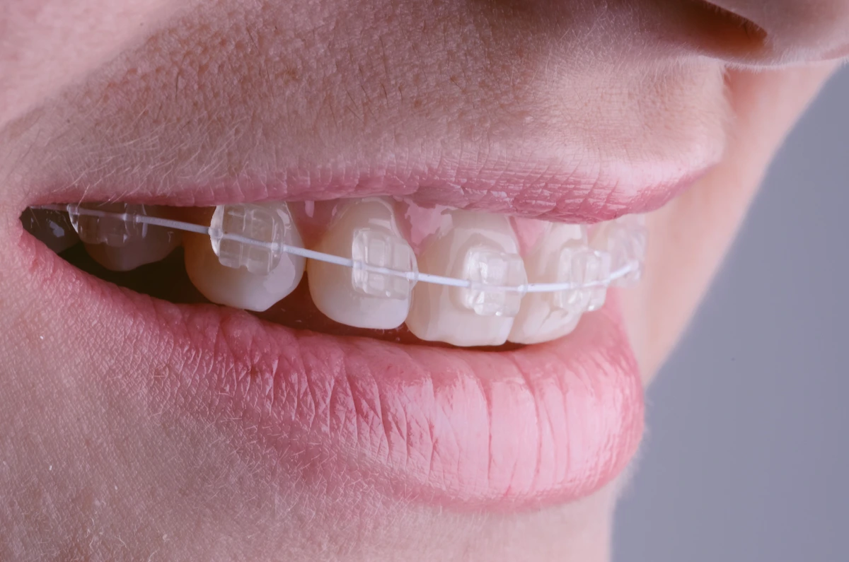 Braces cost Myrtle Beach